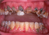 dental issues from meth use